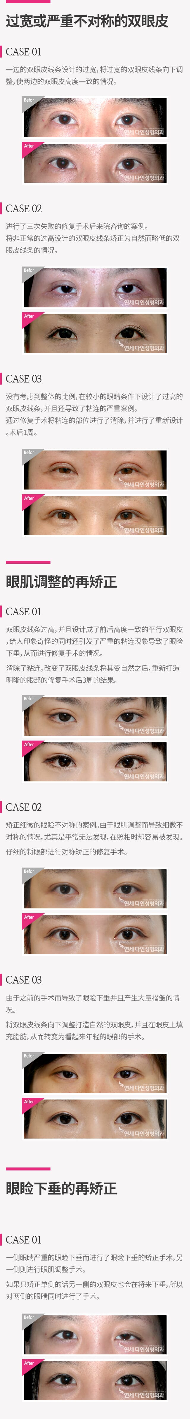 눈재수술