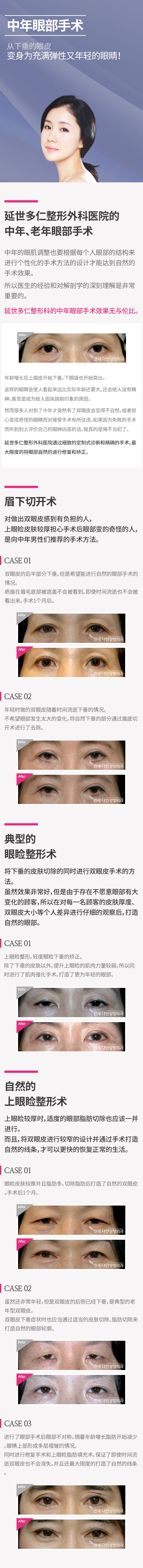 중년눈수술