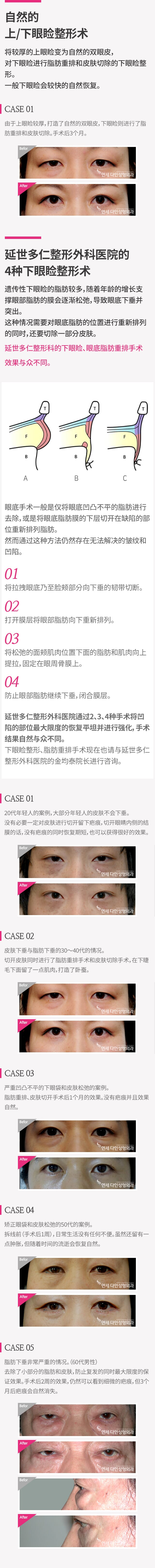 중년눈수술