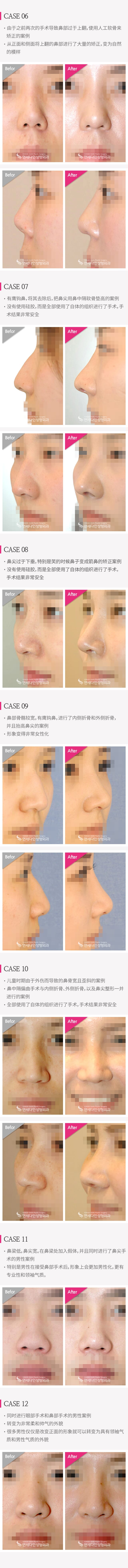 코수술