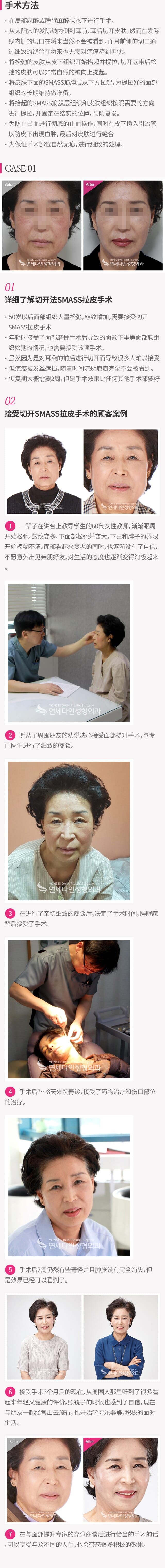 리프팅
